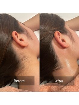 サロン ド ナビ 岡山店(Salon de NABI)/うなじダブル脱毛