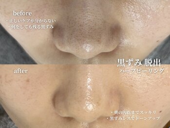 コウル 川西能勢口店(geoul)/毛穴レス美肌コース4回