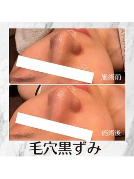 チェンジ(Change)/毛穴黒ずみ