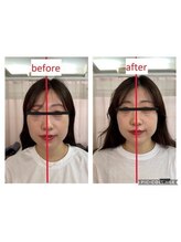 もものき/小顔矯正