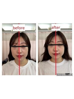 もものき/小顔矯正