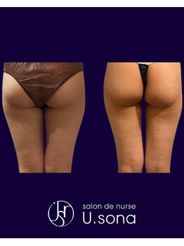 小顔・脂肪コントロール専門 salon de nurse U.sona～松本店～/【痩身】太もも付根脂肪分解症例