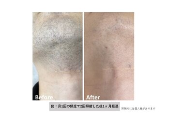 レイカ(Reica)/◆メンズ脱毛（ひげ）