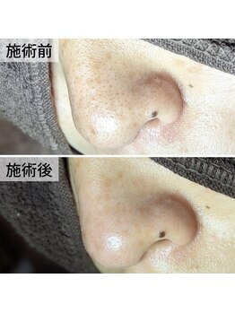 美鼻ラボ 押上 曳舟/詰まり毛穴が内側からスッキリ!