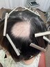 Re:育毛促進鍼◎1～2箇所の頭皮の脱毛に40分　¥5500