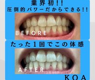 コア(Koa)