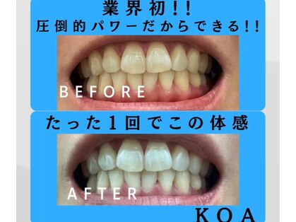 コア(Koa)の写真