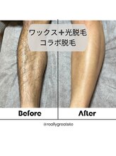 チア(Cheer)/メンズ脚コラボ脱毛