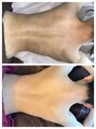 福岡美人工房 アロマムーン グリーンピールで背中/腕/体の毛孔性苔癬やニキビの改善が得意☆