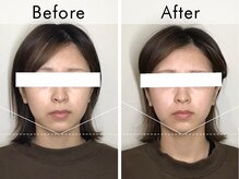 ハリラウンジ 恵比寿本店(Hari Lounge)/美容鍼専門サロン Hari Lounge