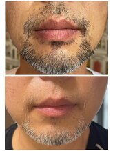 ビヨウイリョウテイケイ プリード(美容医療提携 PULIDO）)/髭脱毛