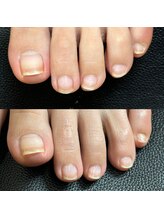 リリ(lili)/トータルフットケア1回目