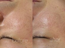 エムフロート(M float)/ハーブピーリング｜ニキビ