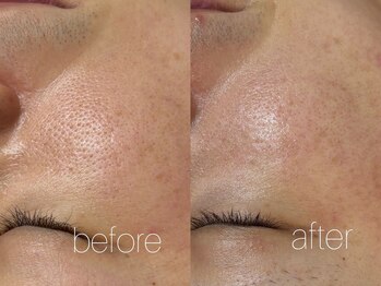 エムフロート(M float)/ハーブピーリング|ニキビ