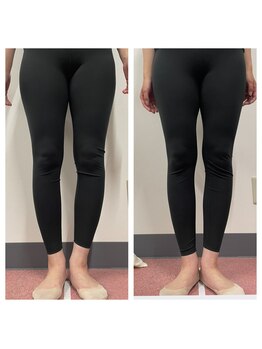 いわき美容整体院/O脚矯正