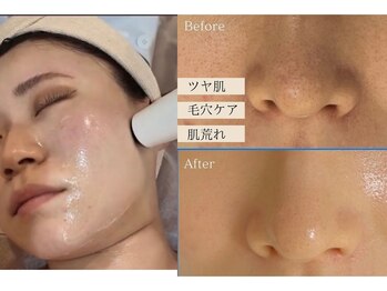 ブレス(Breath)/フェイスライン気になる方へ