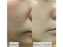 REVIハーブピーリングで肌質を変え、肌を育てていきます。