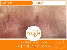 まいれ鍼灸院整骨院 整体院 草津院/ハイドラフェイシャル/角栓