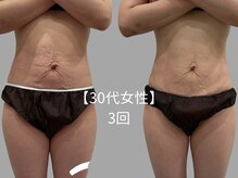 サロン ディシス(salon disis)/【30代　産後のお腹が！】