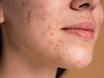 アヴェーラ メンズ店(Avela Men's)の写真/【男のニキビ・毛穴ケア&顔脱毛コース¥5,000】美容男子に人気メニュー♪肌ケアと脱毛が一気にできる★