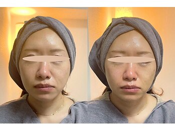 マザートウキョウ(Mother TOKYO)/小顔・中顔面短縮☆