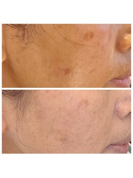 ビハダ(BeHADA)/毛穴/ニキビケア/シミしわ改善