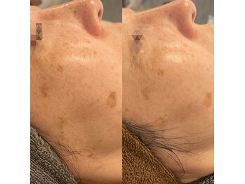 モルセラ(Moluccella)/3回の施術