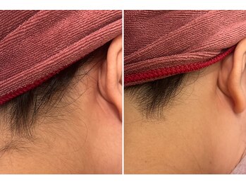 ビューティービレッジ(Beauty village)/耳の後ろもキレイに脱毛