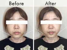 ハリラウンジ 恵比寿本店(Hari Lounge)/美容鍼専門サロン Hari Lounge