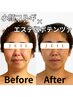 【徹底リフト美顔】小顔コルギ×高周波《毛穴/肩こり/シワ改善に◎》 ¥18000