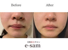 イーサム 高槻摂津富田店(e-sam)/顔脱毛