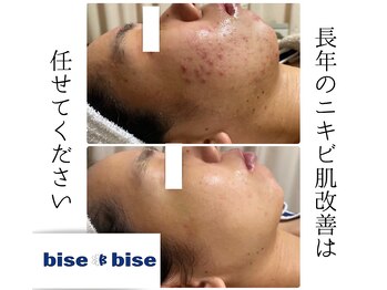 ビズビズ 天王寺店(bisebise)の写真/【医療提携】皮膚科でもダメだった何をしてもダメだったくり返すニキビに終止符！消えない赤み跡根本改善