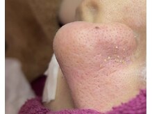 レーヌ(Reine)/まずは角栓取り除こう