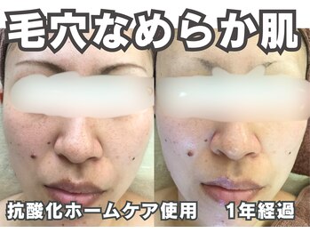 フェイス(FACE)/施術経過