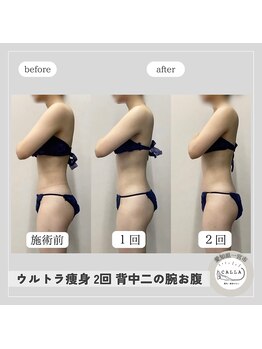 カラー(CALLA)/華奢魅せ☆二の腕と背中くびれ