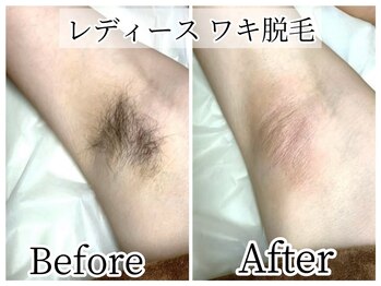 イデアルボーテ/脱毛初心者でも安心の都度払い