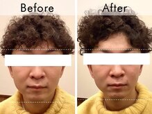 ハリラウンジ 恵比寿本店(Hari Lounge)/美容鍼専門サロン Hari Lounge