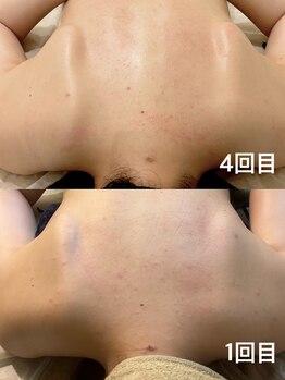 十美/リンパマッサージbefore after