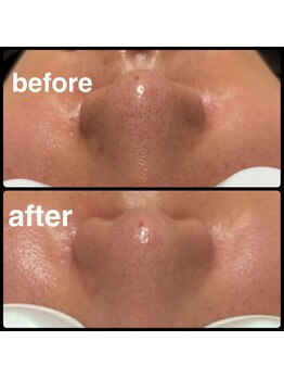 クリアボックス(Clear box)/【本気の毛穴洗浄】