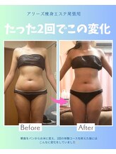 アリーズ エステ スウェイ(ally's esthe sway)/before,after