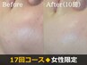 【顔脱毛×17回】一生モノの素肌投資。産毛・くすみ一掃。ノーファンデ肌へ