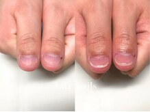 アーティネイルズ(Aaty Nails)/【深爪矯正】ハンド