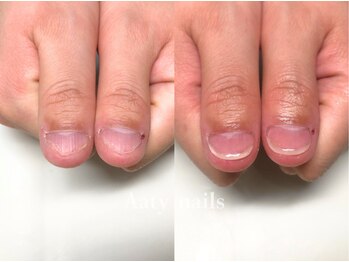 【深爪矯正】ハンド