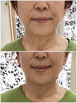 モアクリスタル(More Crystal)の写真/人気！フェイスラインのもたつき改善！スッキリラインで若々しい印象に◎シワたるみほうれい線も改善！