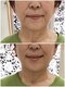 モアクリスタル(More Crystal)の写真/人気！フェイスラインのもたつき改善！スッキリラインで若々しい印象に◎シワたるみほうれい線も改善！