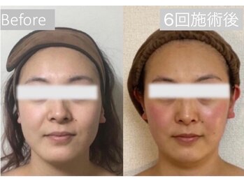 ハーシークレット(Her secret)の写真/超音波で筋膜層に働きかけたるみをケア！理想の小顔を目指すブライダルにも最適☆