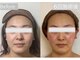 ハーシークレット(Her secret)の写真/超音波で筋膜層に働きかけたるみをケア！理想の小顔を目指すブライダルにも最適☆