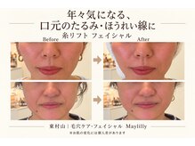 メイリリー(Maylilly)の雰囲気（光・糸リフトでたるみ改善♪口元・ほうれい線のお悩みに）
