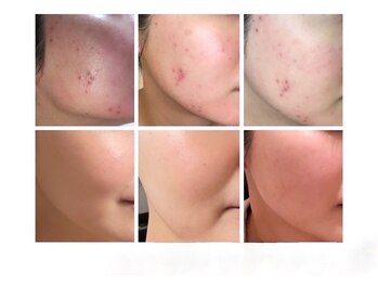 ゾーンビューティーハウス 松戸店(ZONE BEAUTY HOUSE)/REVI陶肌 ニキビケア6回コース