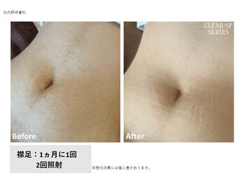 レクリエイター(Re:QREATOR)/セルフ脱毛(before after)